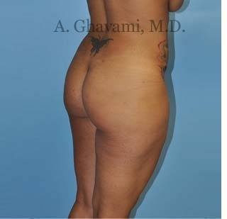 Buttock Augmentation Before & After Patient #8284