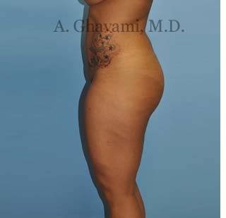Buttock Augmentation Before & After Patient #8284
