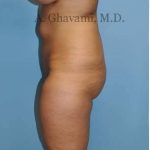 Buttock Augmentation Before & After Patient #8284