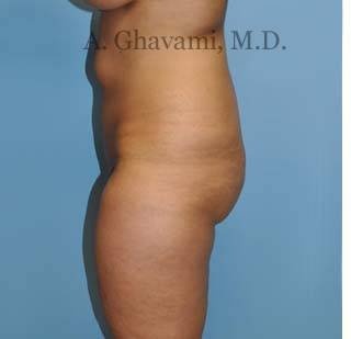 Buttock Augmentation Before & After Patient #8284