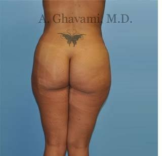 Buttock Augmentation Before & After Patient #8284