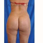 Buttock Augmentation Before & After Patient #7667