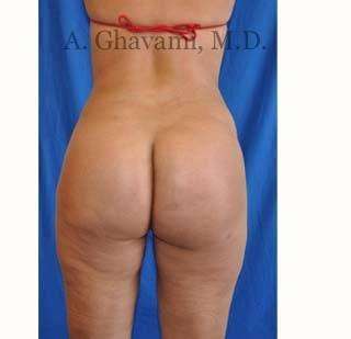Buttock Augmentation Before & After Patient #7667
