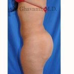 Buttock Augmentation Before & After Patient #7667