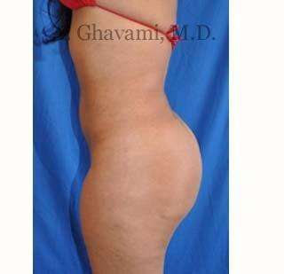 Buttock Augmentation Before & After Patient #7667