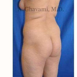 Buttock Augmentation Before & After Patient #7667