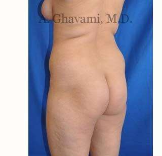 Buttock Augmentation Before & After Patient #7667