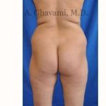 Buttock Augmentation Before & After Patient #7667