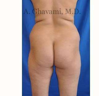 Buttock Augmentation Before & After Patient #7667