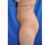 Buttock Augmentation Before & After Patient #7667