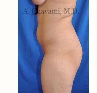 Buttock Augmentation Before & After Patient #7667