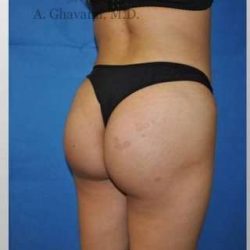 Buttock Augmentation Before & After Patient #7660