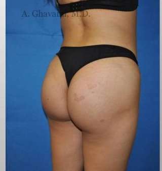 Buttock Augmentation Before & After Patient #7660