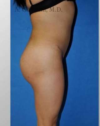 Buttock Augmentation Before & After Patient #7660
