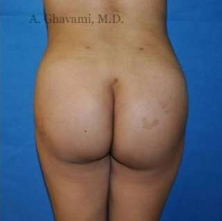 Buttock Augmentation Before & After Patient #7660