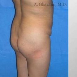 Buttock Augmentation Before & After Patient #7660