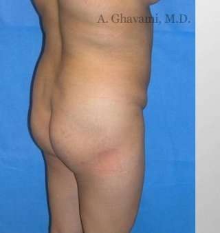 Buttock Augmentation Before & After Patient #7660