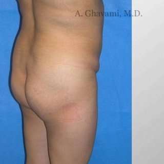 Buttock Augmentation Before & After Patient #7660