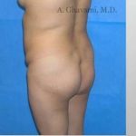 Buttock Augmentation Before & After Patient #7660