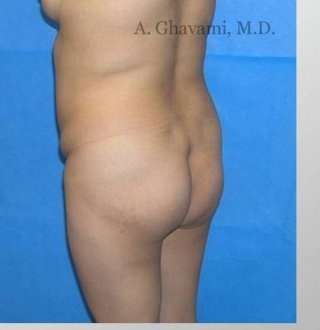 Buttock Augmentation Before & After Patient #7660