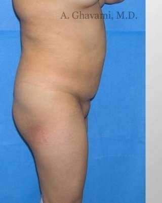 Buttock Augmentation Before & After Patient #7660