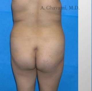 Buttock Augmentation Before & After Patient #7660