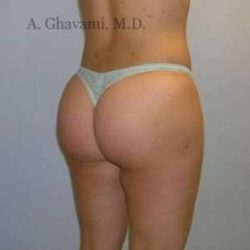 Buttock Augmentation Before & After Patient #7649