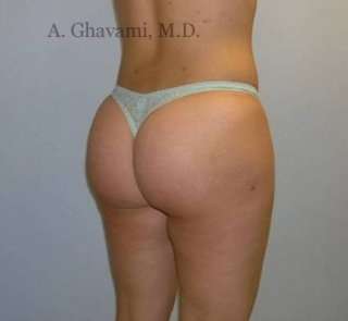 Buttock Augmentation Before & After Patient #7649