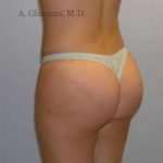 Buttock Augmentation Before & After Patient #7649