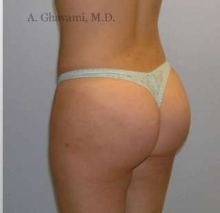 Buttock Augmentation Before & After Patient #7649