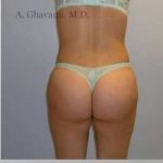 Buttock Augmentation Before & After Patient #7649