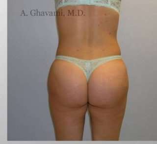 Buttock Augmentation Before & After Patient #7649