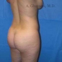 Buttock Augmentation Before & After Patient #7649