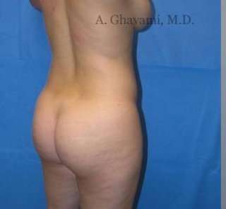 Buttock Augmentation Before & After Patient #7649
