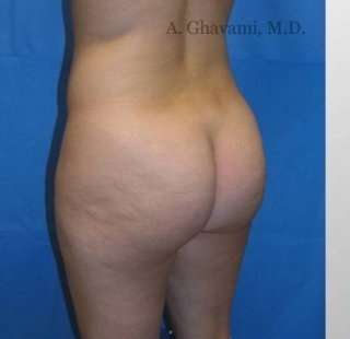 Buttock Augmentation Before & After Patient #7649
