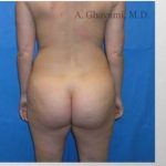 Buttock Augmentation Before & After Patient #7649