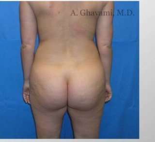 Buttock Augmentation Before & After Patient #7649