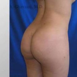 Buttock Augmentation Before & After Patient #7642