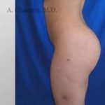 Buttock Augmentation Before & After Patient #7642