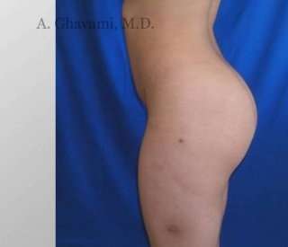 Buttock Augmentation Before & After Patient #7642