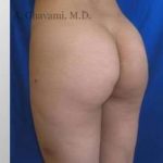 Buttock Augmentation Before & After Patient #7642