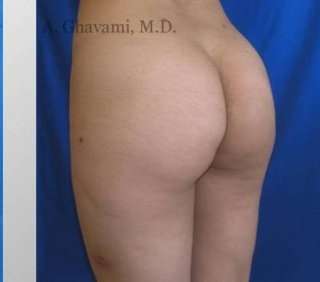 Buttock Augmentation Before & After Patient #7642