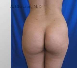 Buttock Augmentation Before & After Patient #7642