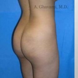 Buttock Augmentation Before & After Patient #7642