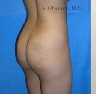 Buttock Augmentation Before & After Patient #7642