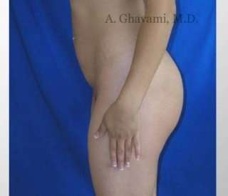 Buttock Augmentation Before & After Patient #7642