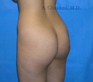 Buttock Augmentation Before & After Patient #7642