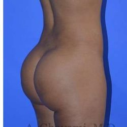 Buttock Augmentation Before & After Patient #7633