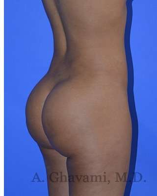Buttock Augmentation Before & After Patient #7633