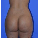 Buttock Augmentation Before & After Patient #7633